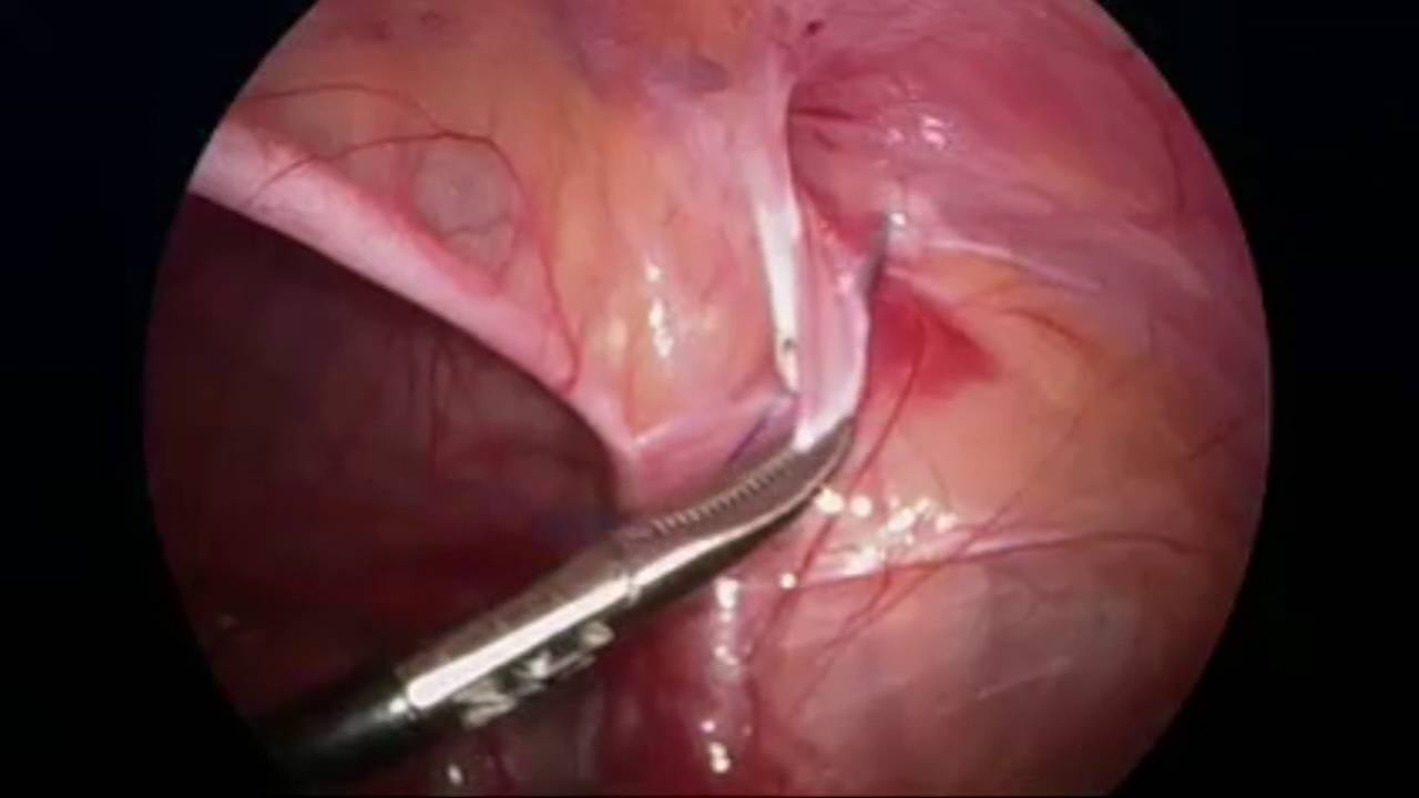 腹腔鏡下鼠径ヘルニア修復 ガール 女性 国際小児endosurgeryグループ