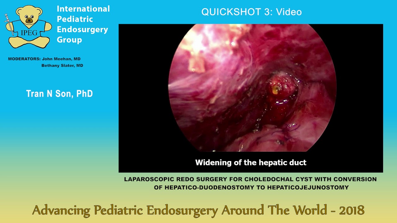肝十二指腸吻合術轉換為肝腸吻合術的膽囊囊腫腹腔鏡重做手術- 國際小兒 
