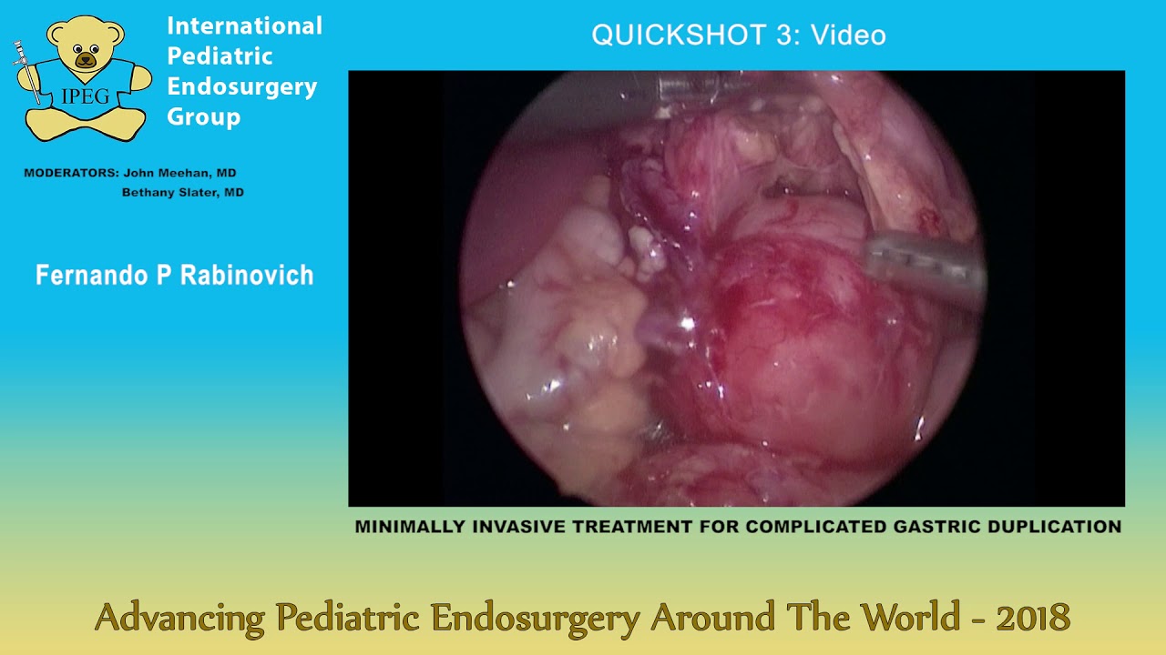 MINIMALLY INVASIVE TREATMENT FOR COMPLICATED GASTRIC DUPLICATION -  International Pediatric Endosurgery Group