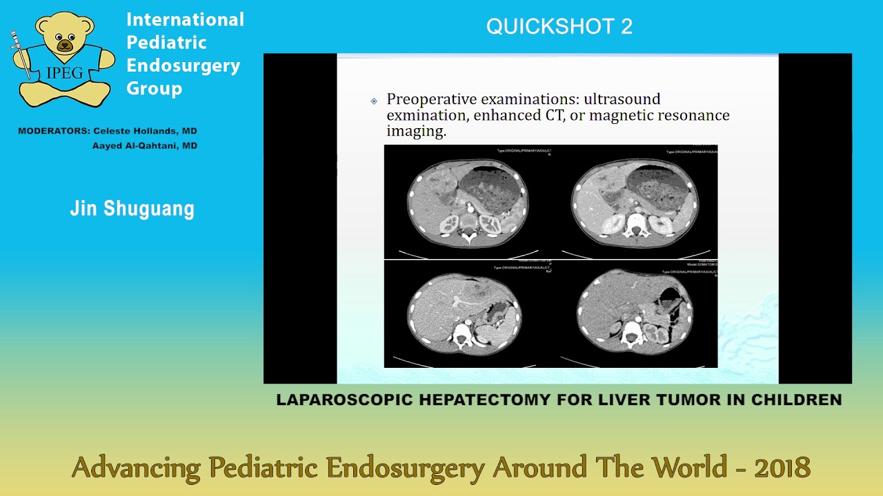 LAPAROSCOPIC HEPATECTOMY FOR LIVER TUMOR IN CHILDREN LAPAROSCOPIC HEPATECTOMY FOR LIVER TUMOR IN CHILDREN