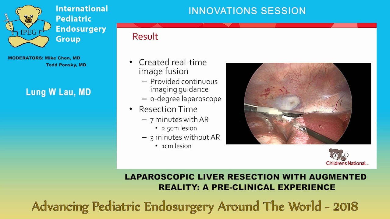 LAPAROSCOPIC LIVER RESECTION WITH AUGMENTED 