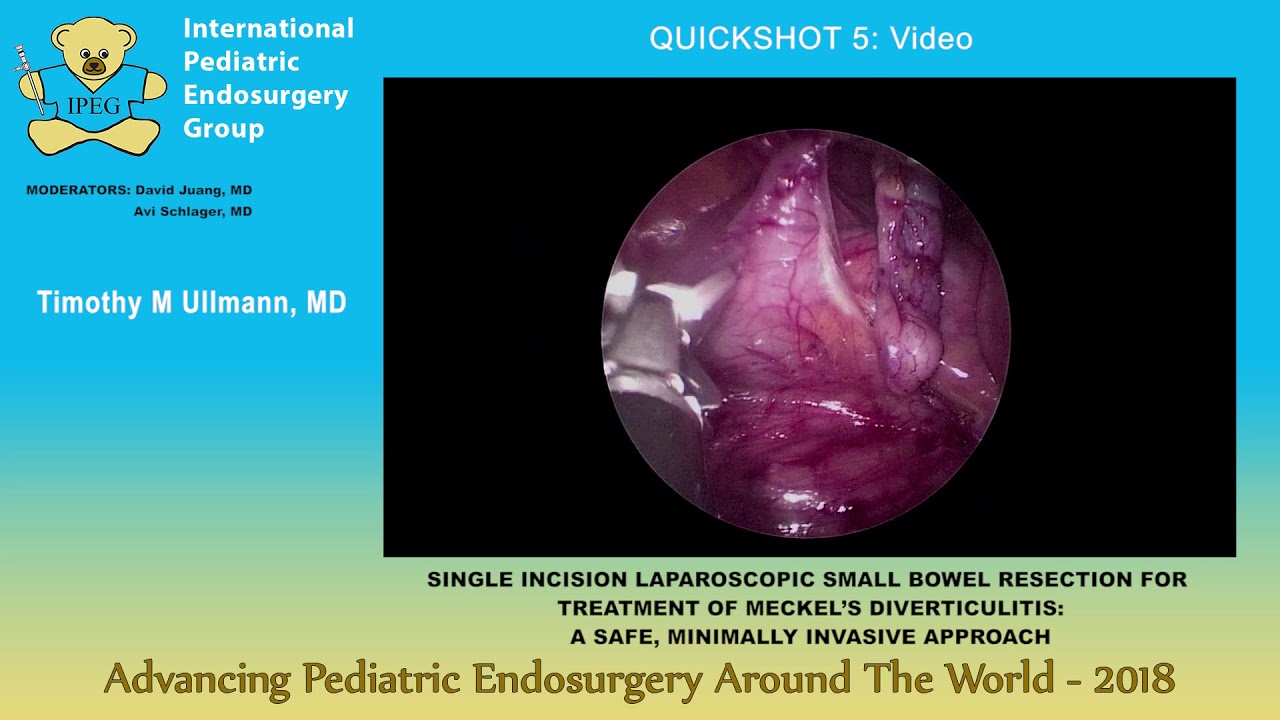 SINGLE INCISION LAPAROSCOPIC SMALL BOWEL RESECTION FOR TREATMENT 