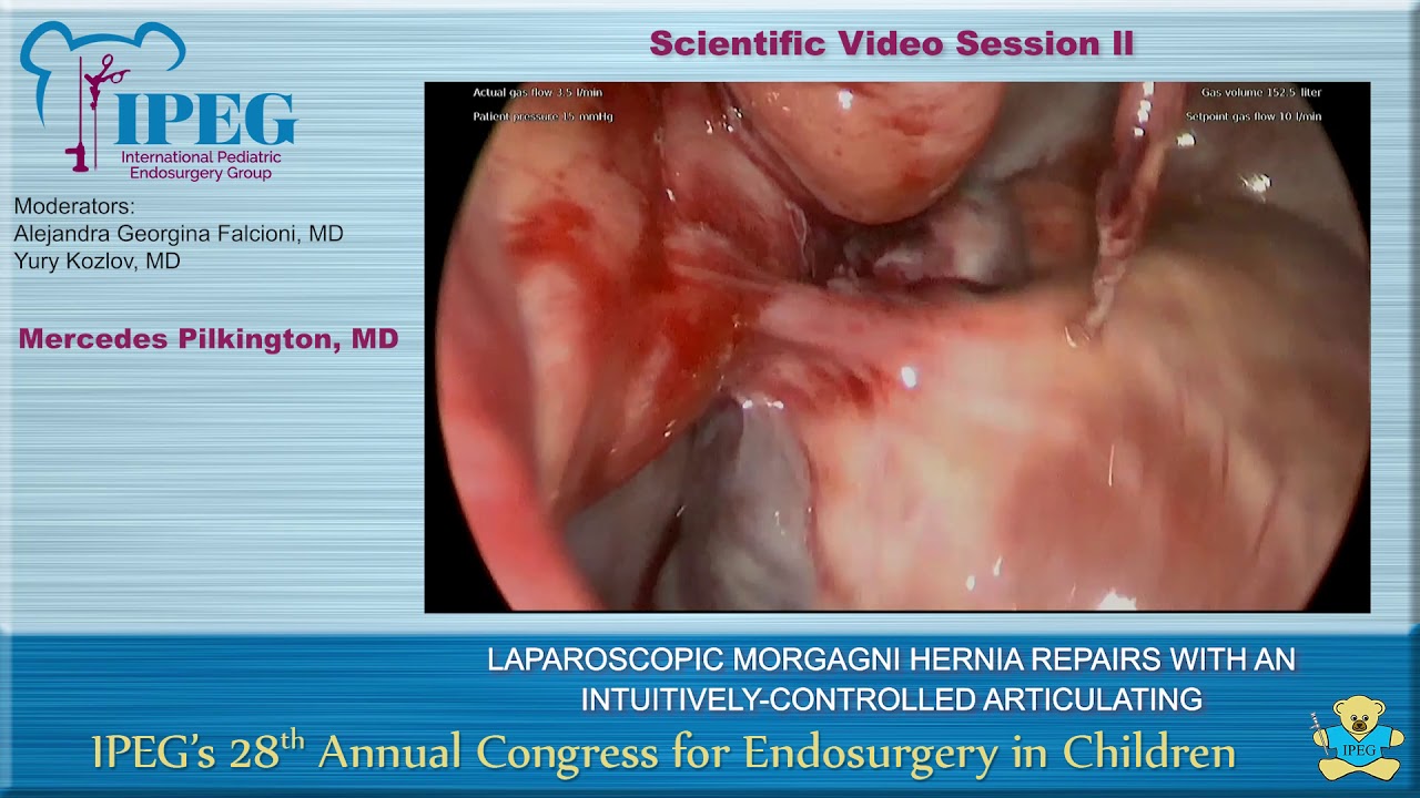 LAPAROSCOPIC MORGAGNI HERNIA REPAIRS WITH AN INTUITIVELY 