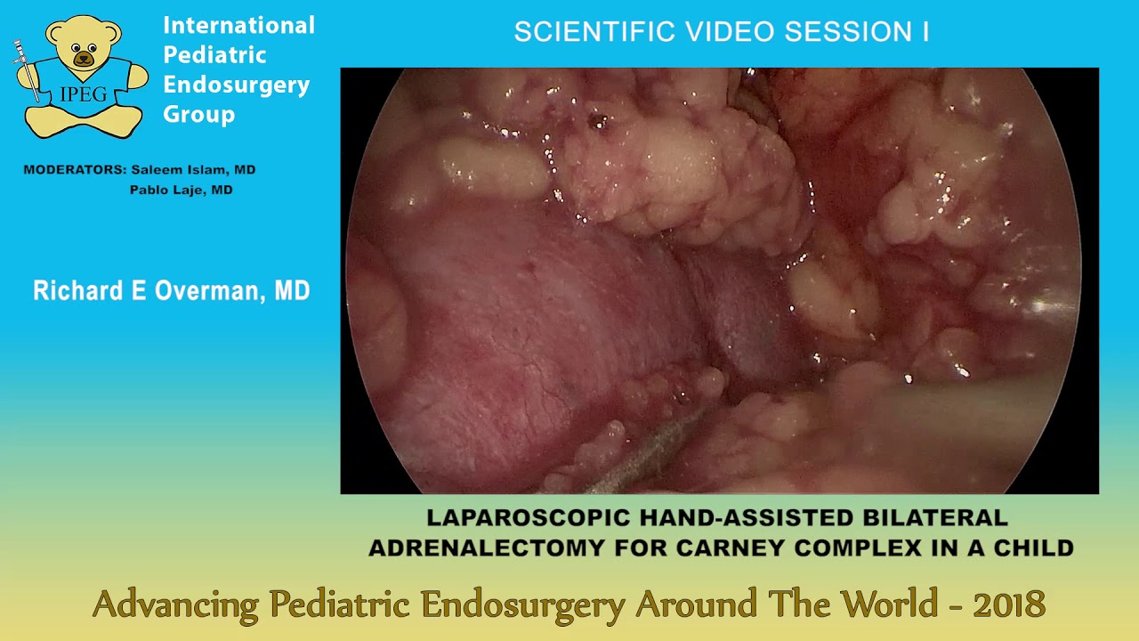 LAPAROSCOPIC HAND-ASSISTED BILATERAL ADRENALECTOMY FOR CARNEY 